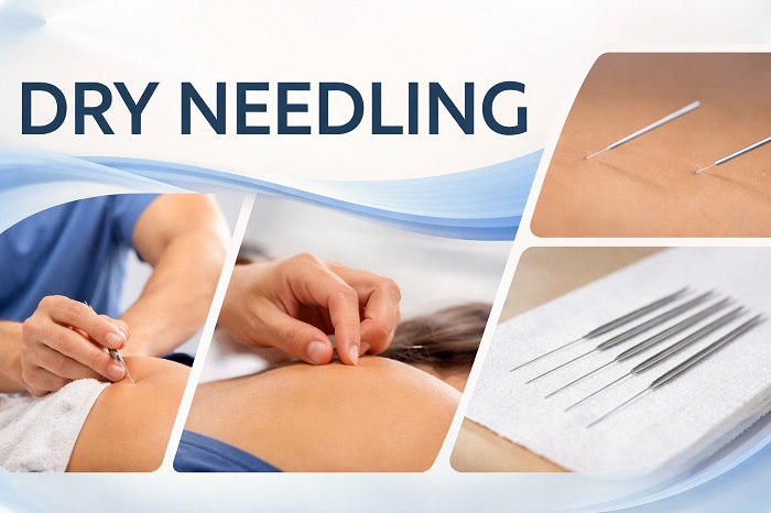 Dry Needling